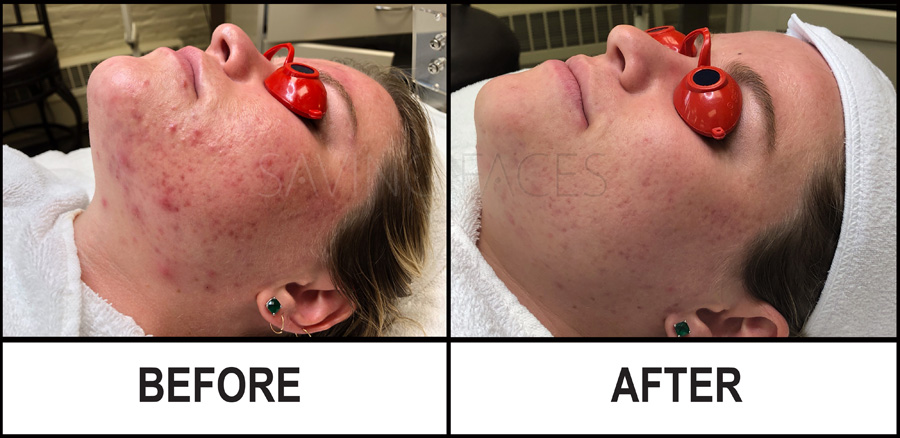 Saving Faces - Before and After Acne Treatments